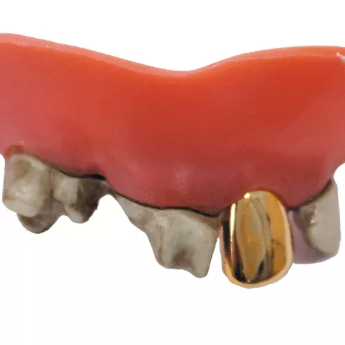 DENTIER DENTS POURRIES+OR (nécessaire de fixation inclus)